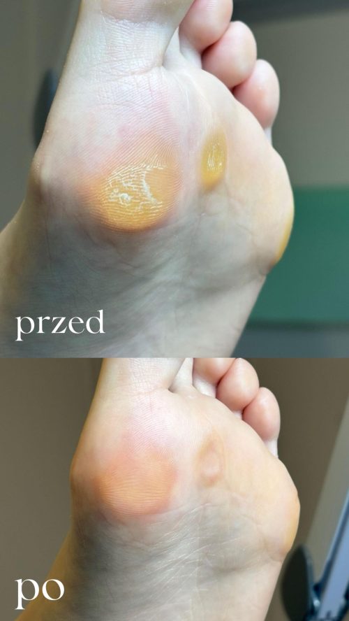 Kiedy pedicure kosmetyczny nie wystarcza - rola podologa w dbaniu o stopy.1