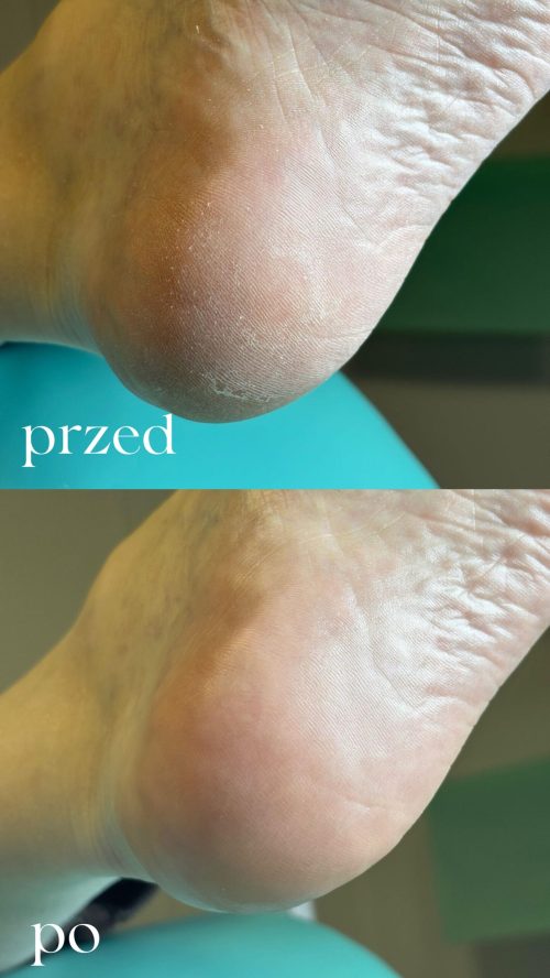 Kiedy pedicure kosmetyczny nie wystarcza - rola podologa w dbaniu o stopy.2